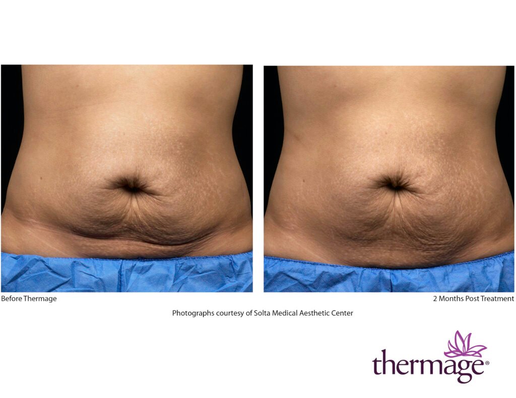 thermage before after smac 01 thermage before after smac 01