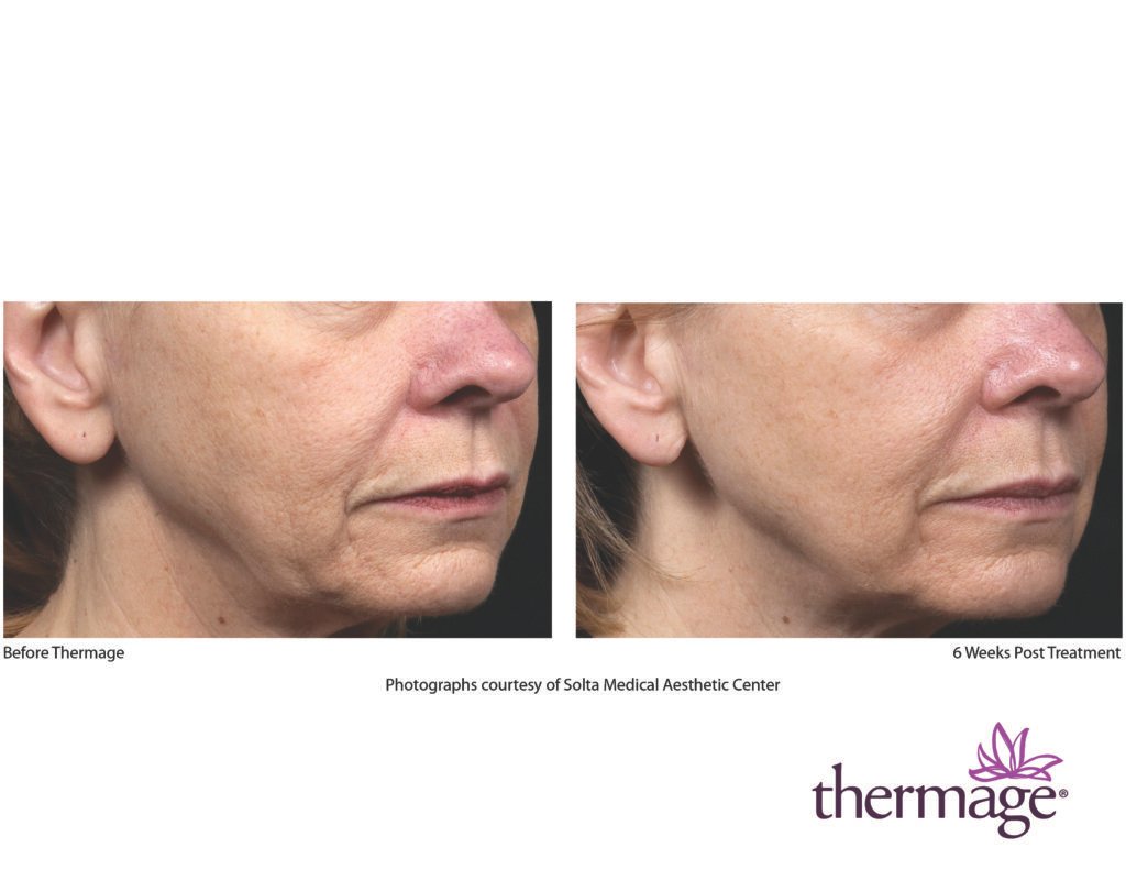 thermage before after smac 02 thermage before after smac 02