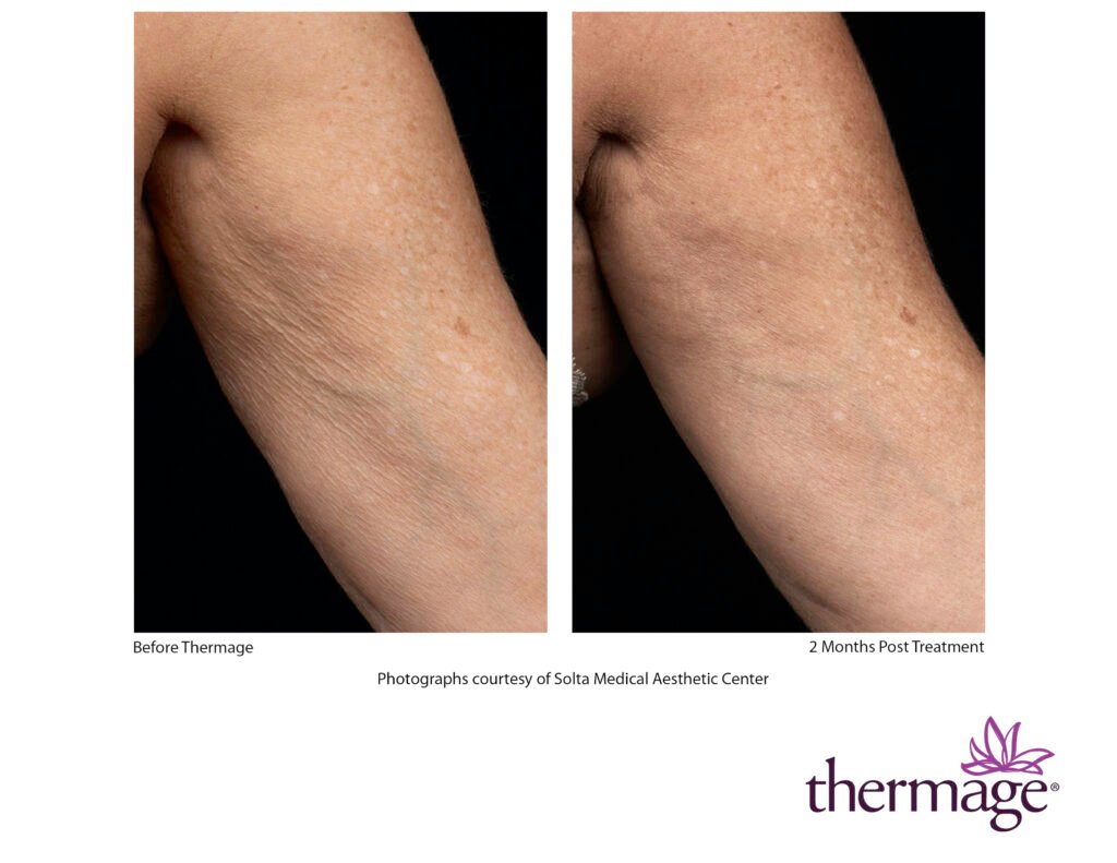 thermage before after smac 03 thermage before after smac 03