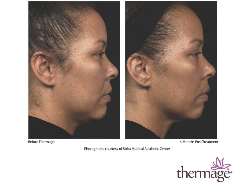 thermage before after smac 04 thermage before after smac 04