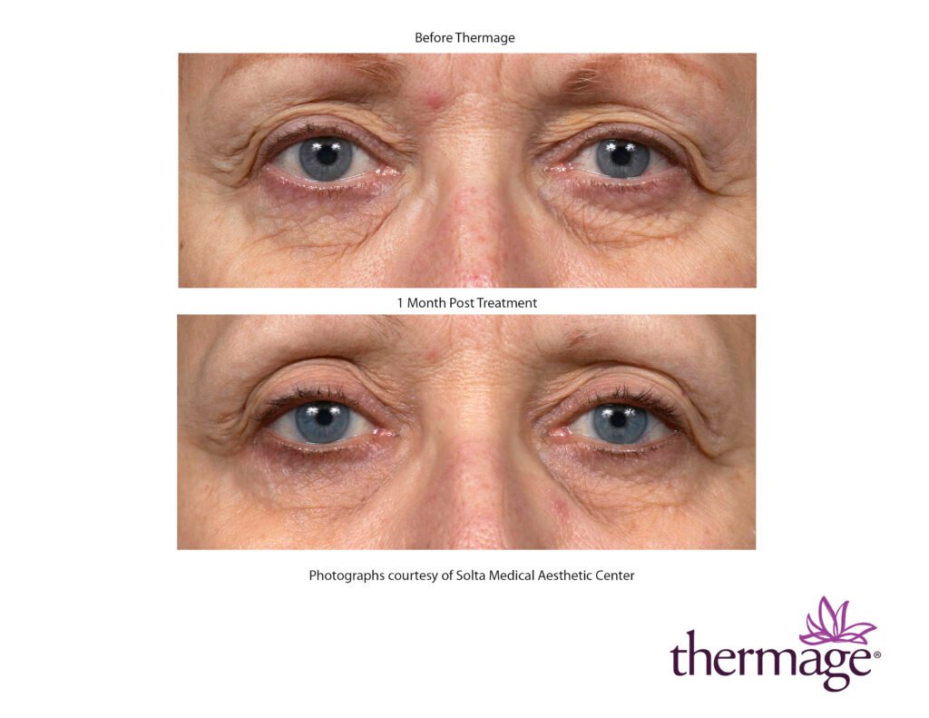 thermage before after smac 05 thermage before after smac 05