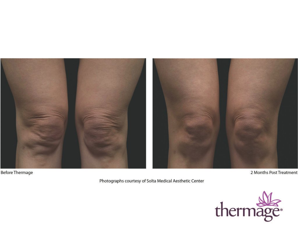 thermage before after smac 06 thermage before after smac 06