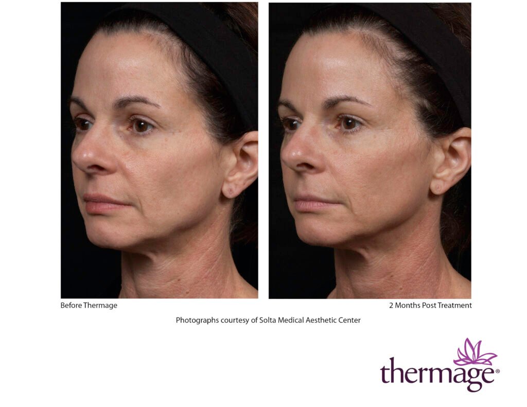 thermage before after smac 07 thermage before after smac 07
