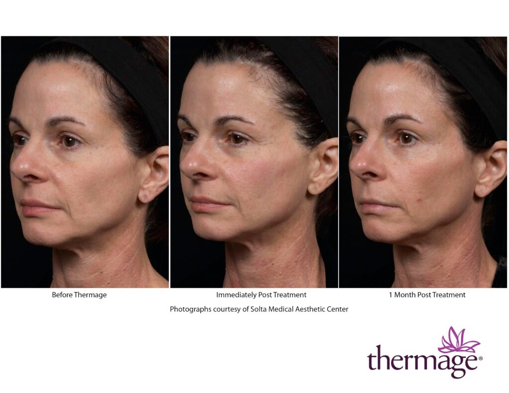 thermage before after smac 08 thermage before after smac 08