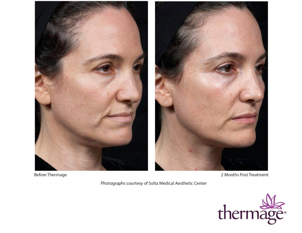 thermage before after smac 09 thermage before after smac 09
