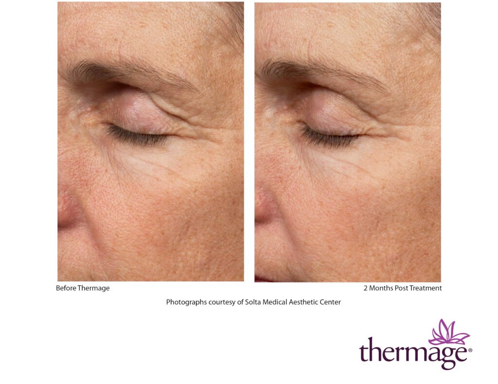 thermage before after smac 10 thermage before after smac 10