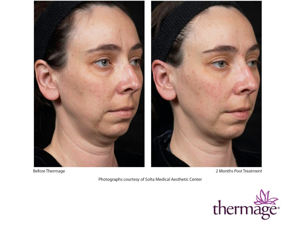 thermage before after smac 11 thermage before after smac 11