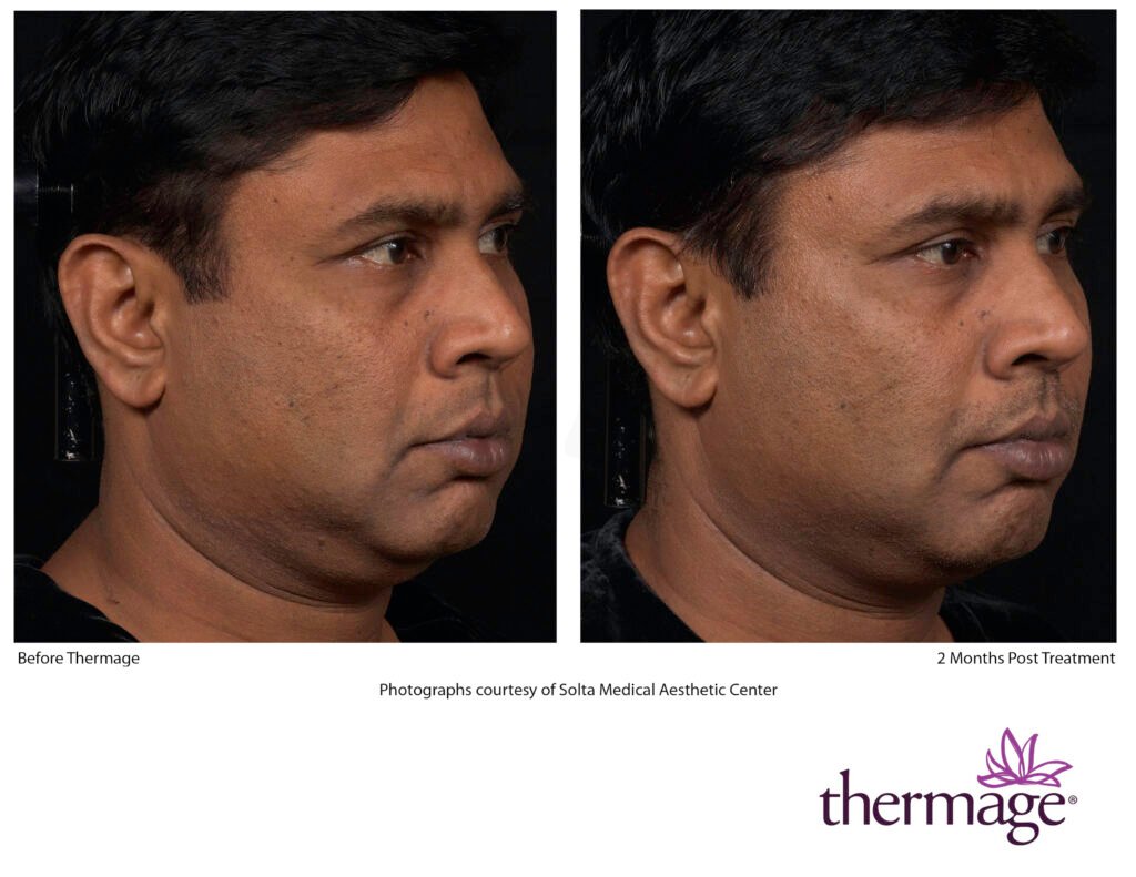 thermage before after smac 12 thermage before after smac 12