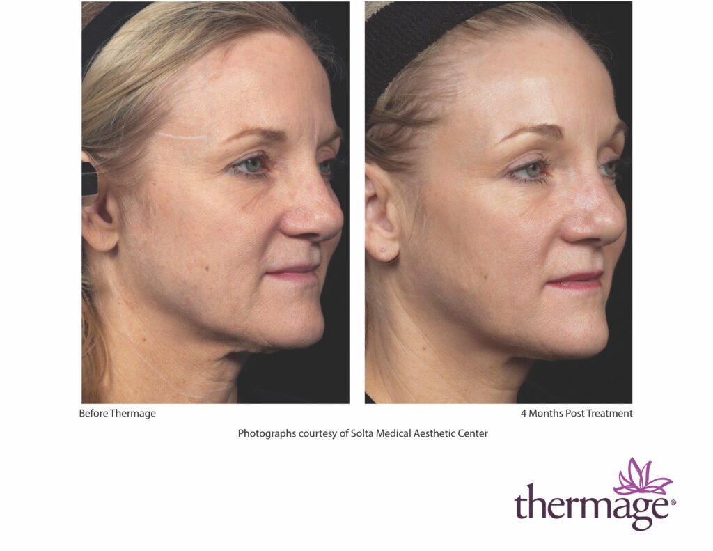 thermage before after smac 14 thermage before after smac 14