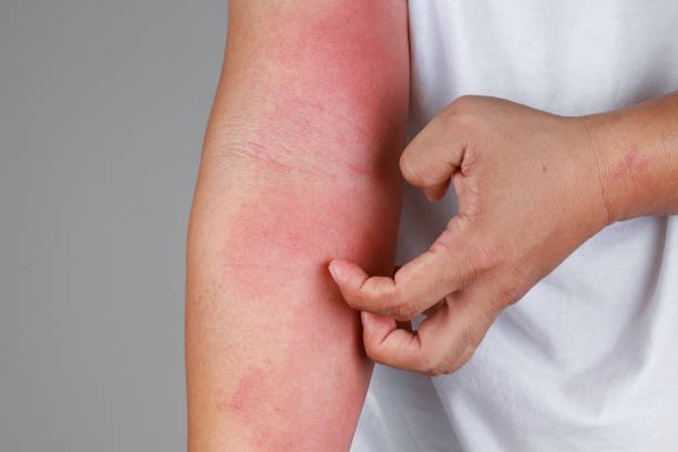 a close up of bad psoriasis on a person's arm a close up of bad psoriasis on a person's arm