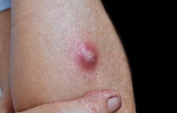 large carbuncle or abscess at forearm of asian burmese male patient. large carbuncle or abscess at forearm of asian burmese male patient.